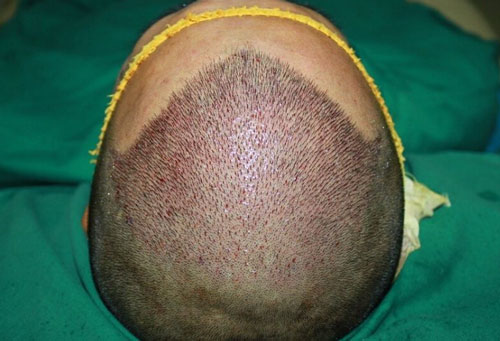 深圳倍生微针植发技术一次成型，毛囊损伤更小