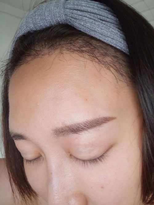 深圳做植发手术后多久能长出头发?