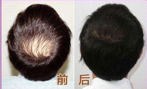深圳植发医院哪家做头发加密比较好？