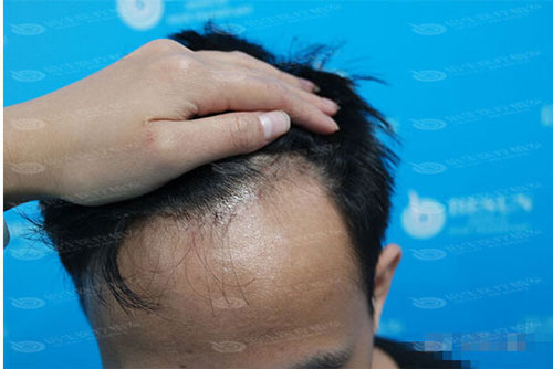 深圳倍生植发手术有危险吗？