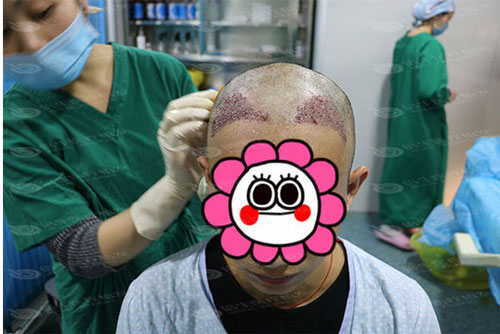 深圳倍生植发手术有危险吗？