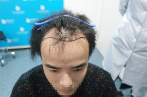 植发案例：秃成大叔，被女友吐槽后，小伙决定去植发