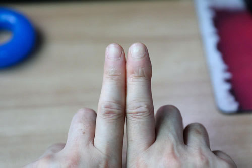 廖骏长年植发导致右手手指粗壮