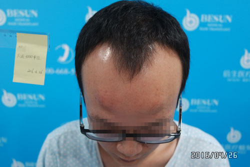 植发案例：M型脱发，倍生植发3000单位，自信和形象的拯救之旅