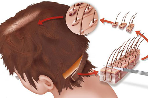 自体毛发移植是治疗脱发的最好方法吗?