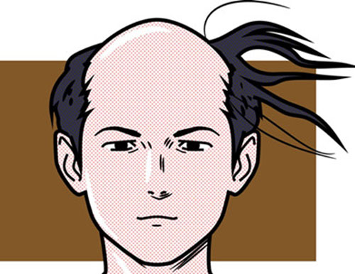 毛发移植技术