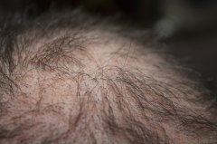 头发加密种植和头发种植有什么区别吗?