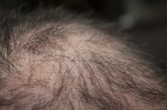 倍生SEP植发技术，头发种植密度竟达到这个数