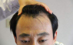 男性脱发采用SEP植发技术，竟有这样的效果