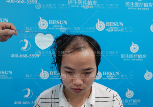 深圳正规三甲植发医院哪家好？