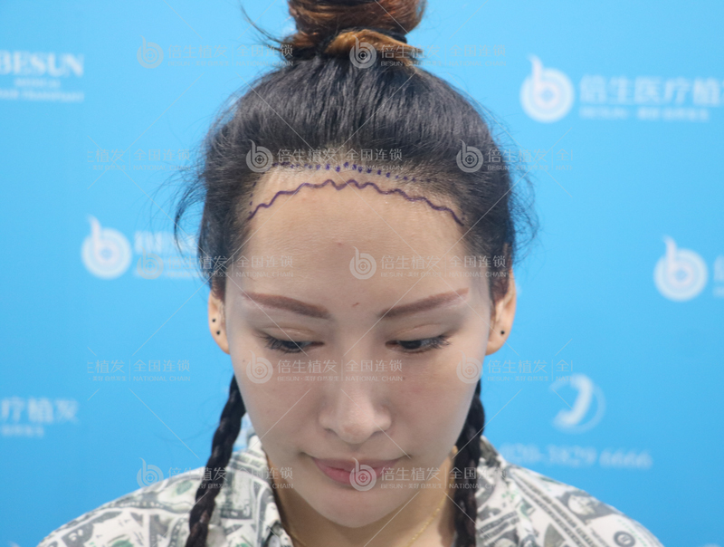 深圳检查头发多少钱，有套路吗？
