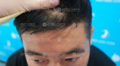 深圳微针植发可以治疗指甲大小的疤痕吗？