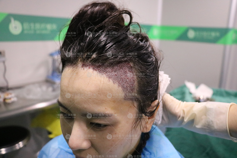 深圳微针植发技术能够治疗遗传性脱发吗？