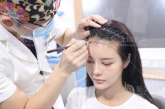 深圳微针植发会损害原生发的毛囊吗？