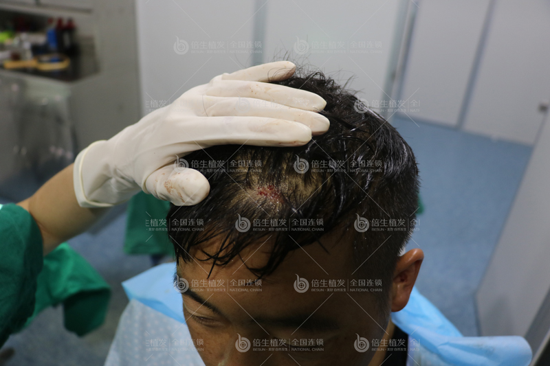 深圳微针植发技术能修复头顶疤痕吗？