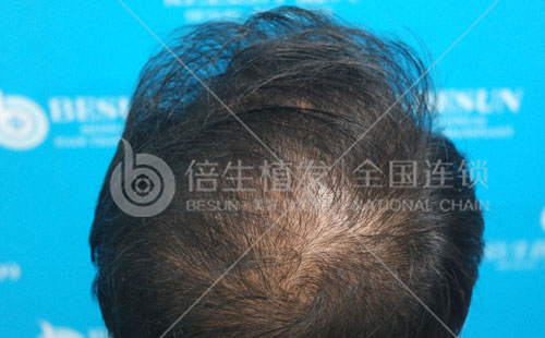 深圳微针植发加密会伤到头顶毛囊吗？