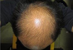 深圳微针植发能治疗遗传性脱发吗？