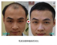 在深圳倍生植发医院植发后发友的头发怎么样了