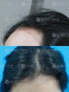 深圳植发后种植的头发不会再出现脱落的情况
