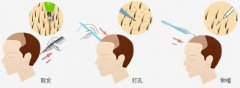 深圳植发可以治疗头发稀疏