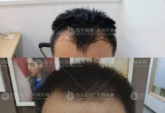 深圳植发可以改善头发稀疏的情况