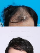 深圳植发能使头发恢复浓密